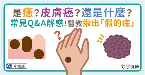 手臂長很多痣|是痣or皮膚癌？醫「1張圖秒對照」 長這2部位最危險